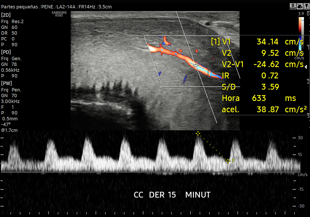DOPPLER DE PENE CON SUSTANCIA VASOACTIVA