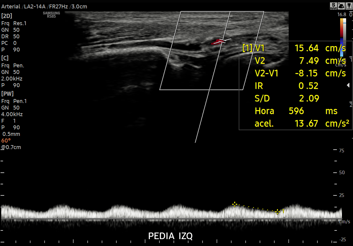 DOPPLER DE ARTERIAL