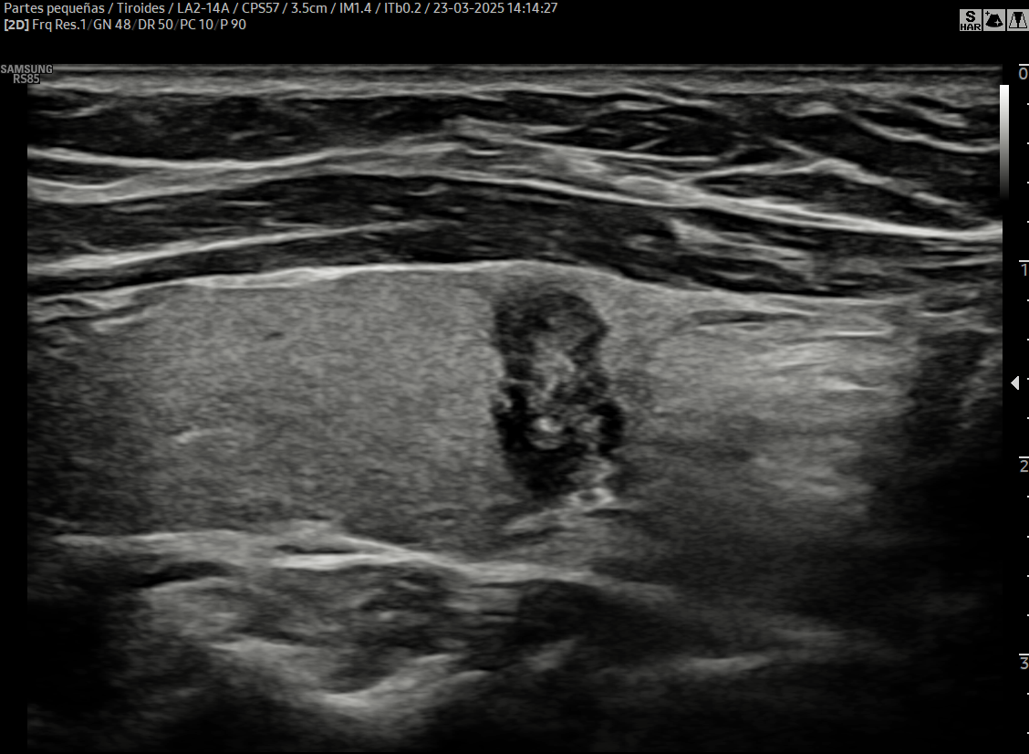 ECOGRAFÍAS DE 2DA OPINIÓN DE TIROIDES