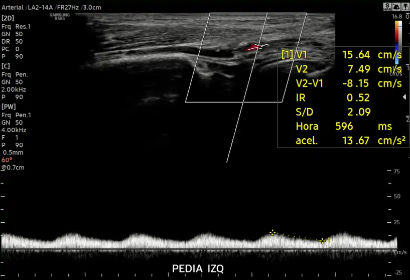 DOPPLER DE ARTERIAL