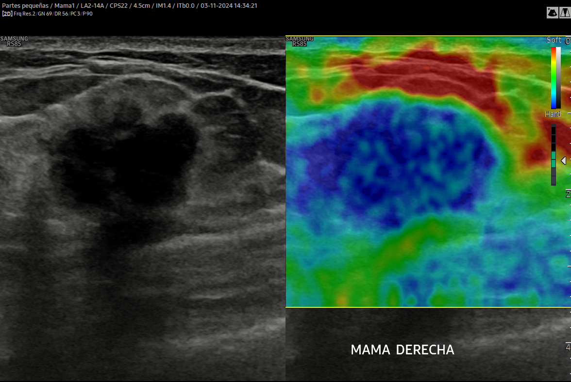 ELASTOGRAFÍA DE MAMA