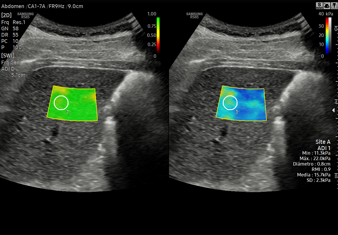ELASTOGRAFÍA DE HÍGADO