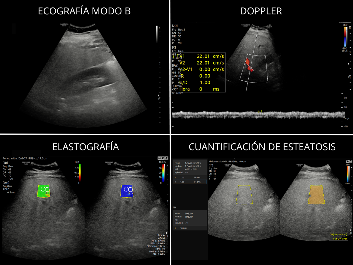 ECOGRAFÍA MULTIPARAMÉTRICA DE HÍGADO