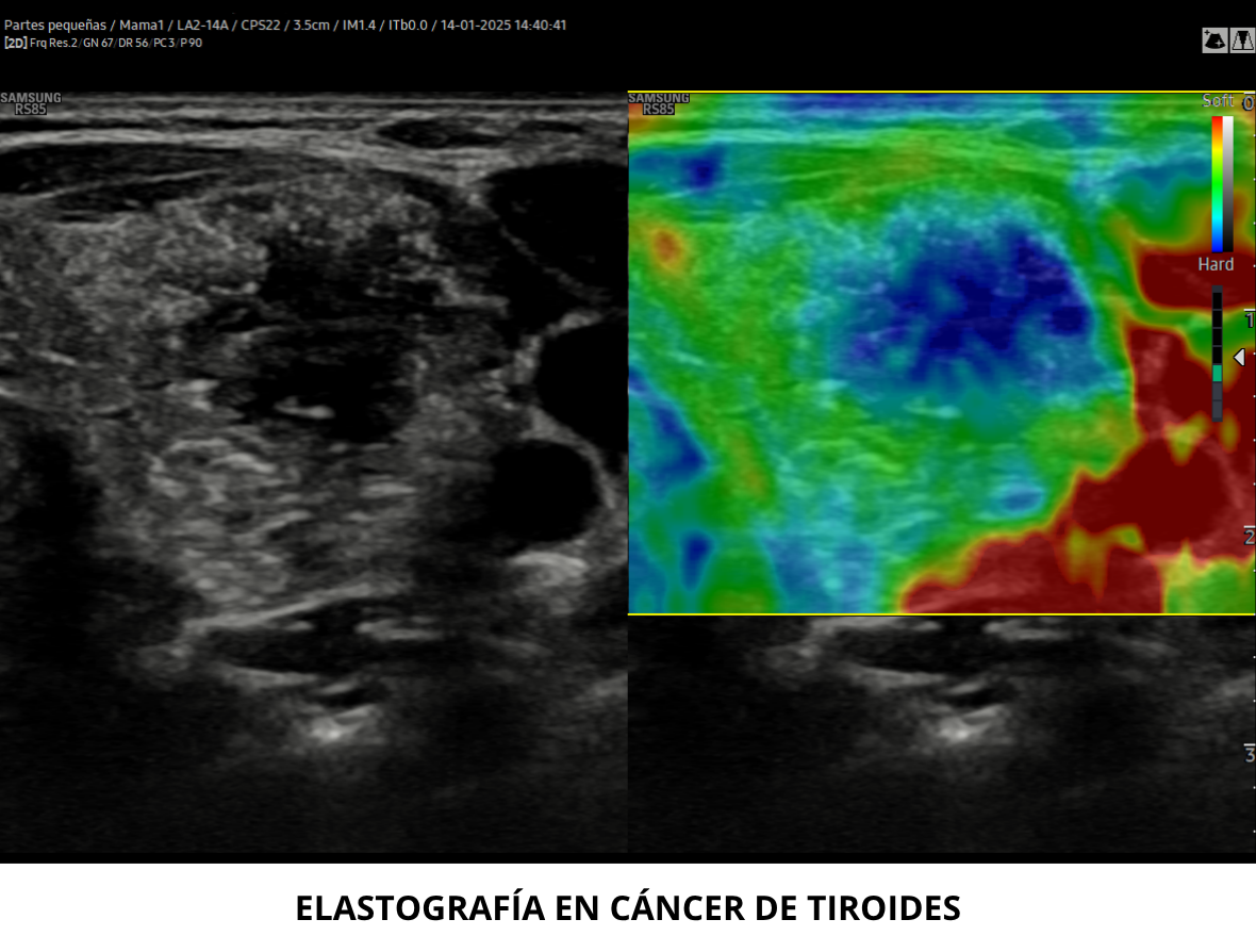 ELASTOGRAFÍA DE TIROIDES