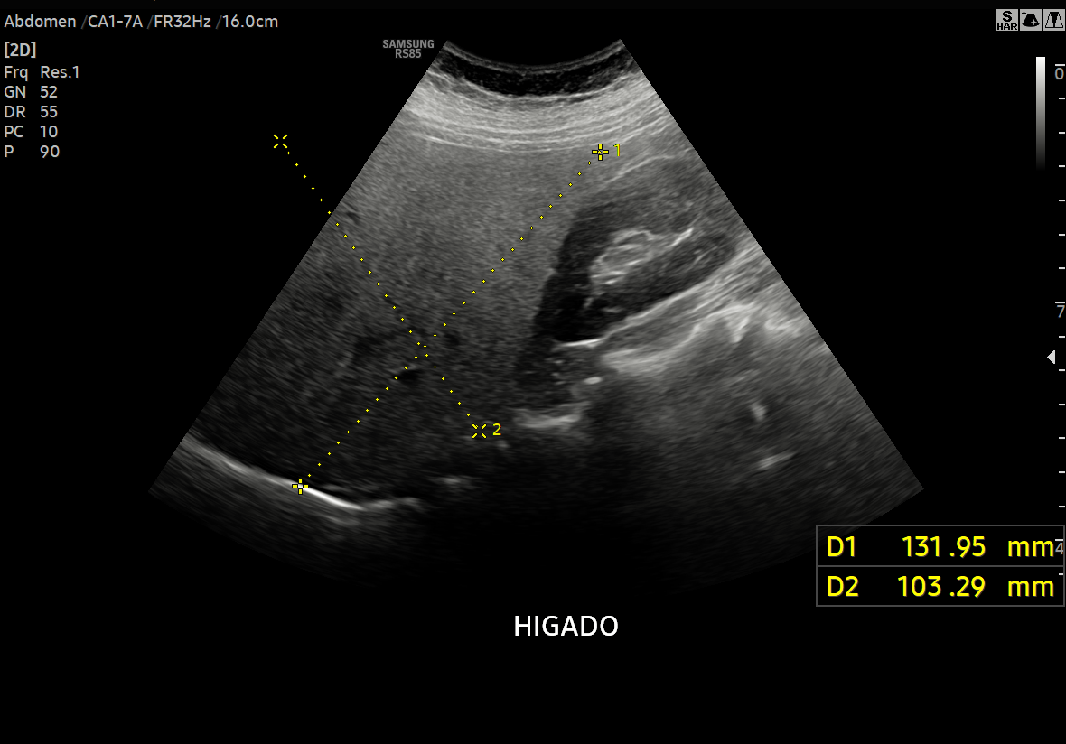 ECOGRAFÍAS DE 2DA OPINIÓN DE HÍGADO